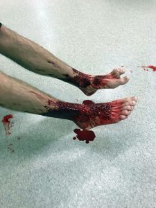 pies sangrando