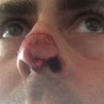 Detenido el futbolista del Molinar que mordió la nariz de un jugador del Son Verí durante un partido el domingo