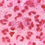 Balears fue la segunda comunidad con más casos de gonorrea y sífilis de 2017